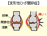 変形性ひざ関節症の原因