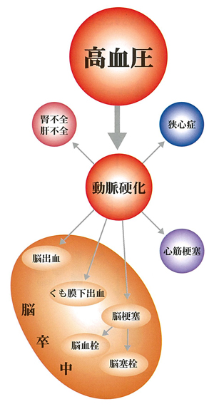 高血圧と合併症